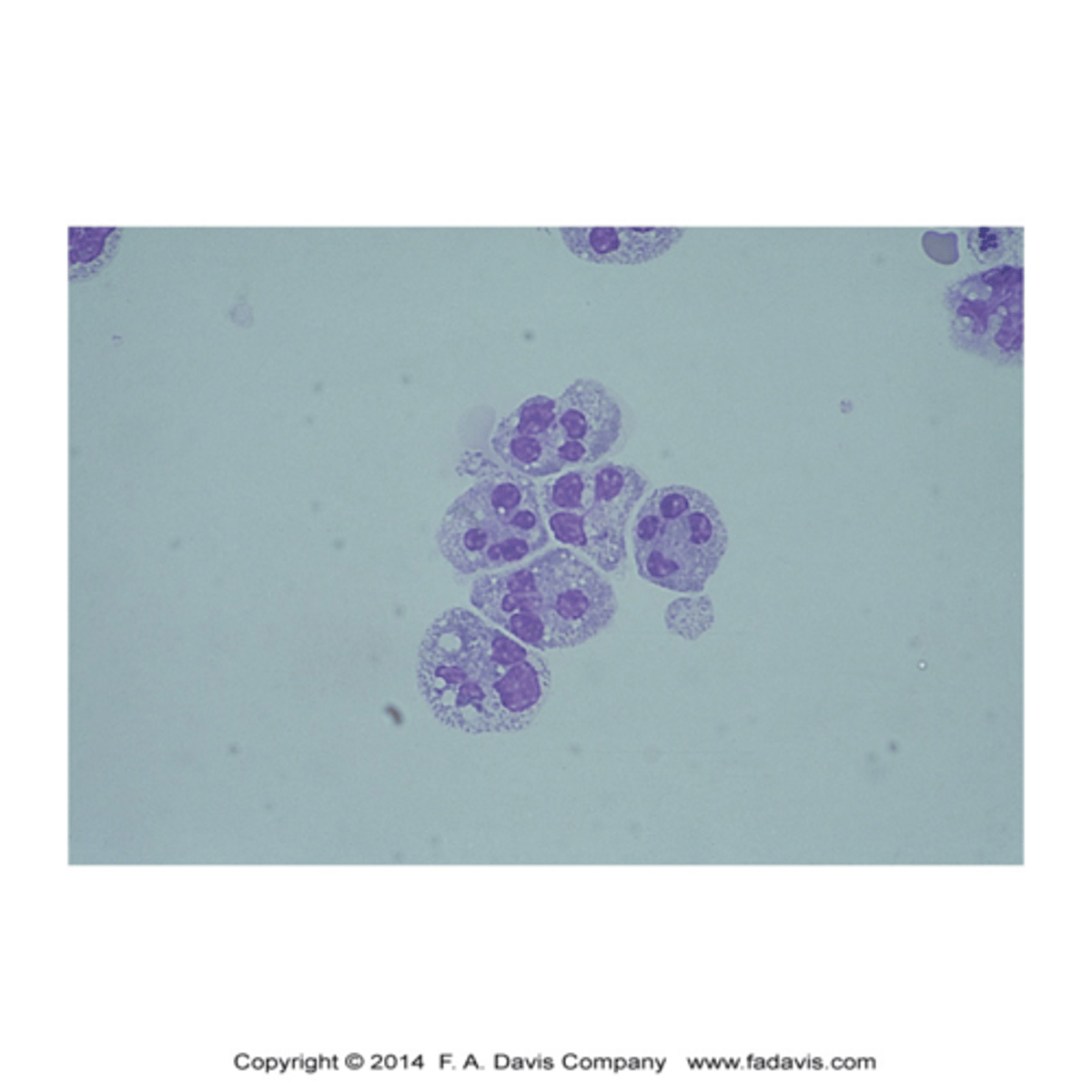 <p>-major clinical significance: Bacterial meningitis/ early cases of viral, tubercular, and fungal meningitis/ cerebral hemorrhage</p><p>-microscopic finding: granules may be less prominent than in blood/ cells disintegrate rapidly</p><p>(image: x500: neutrophils with cytoplasmic vacuoles resulting from cytocentrifugation)</p>