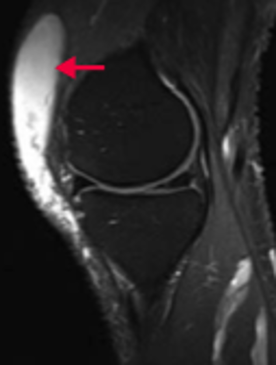 <p>What is prepatellar bursitis?</p><p>- inflammation of the knee's largest sac of synovial fluid</p><p>What causes it?</p><p>- repeated trauma or pressure from excessive kneeling</p>