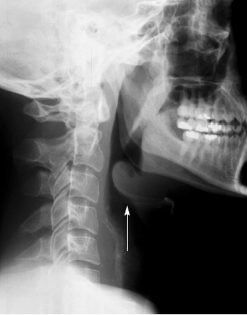 <p>-Clinical findings</p><p>-Laryngoscopy in OR: cherry red epiglottis</p><p>-Lateral neck x-ray: enlarged "Thumbprint sign"</p><p>-Blood cultures</p>