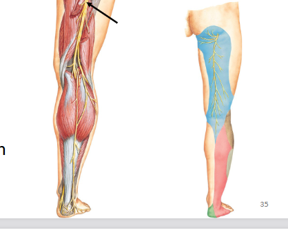 <p>Damage to the Sciatic Nerve </p>