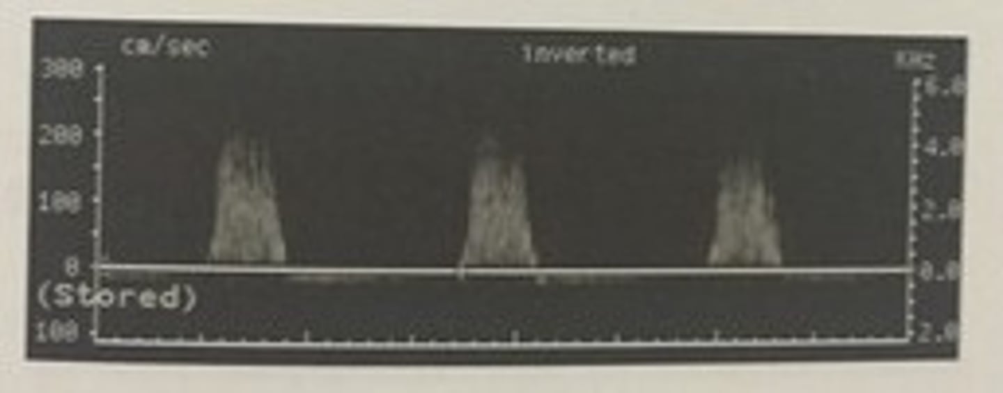 <p>447. (Peripheral arterial measurement techniques)</p><p>This doppler waveform was obtained in a stenotic femoral artery. Was it most likely taken proximal or distal to the site of stenosis?</p>