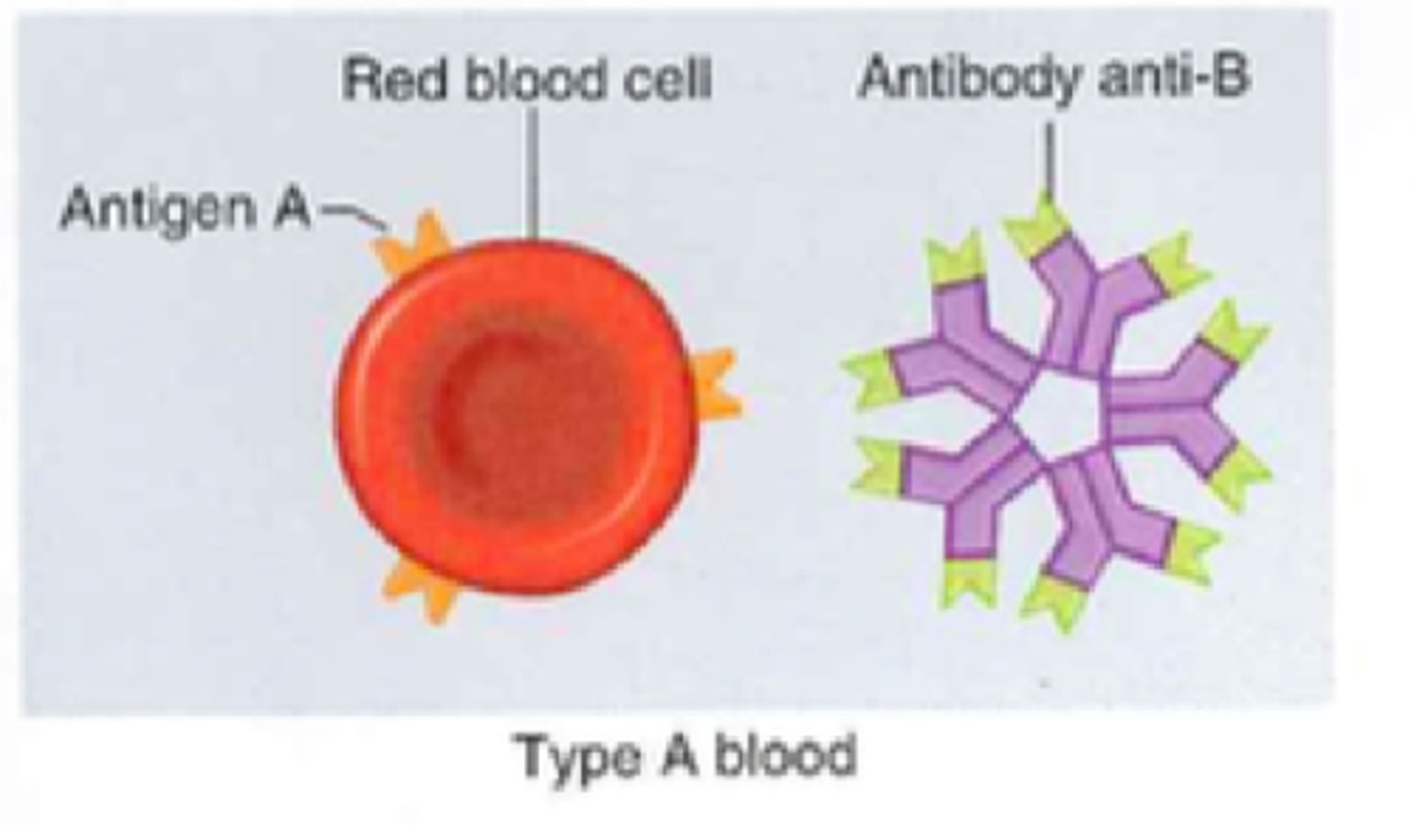 <p>blood that has the A antigen and anti-B antibodies</p>