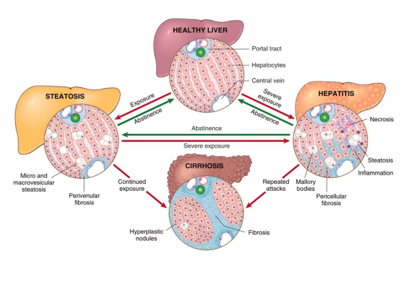 <p>- Excessive ethanol consumption causes more than 60% of cases of chronic liver disease in Western countries and accounts for 40% to 50% of deaths resulting from cirrhosis</p>