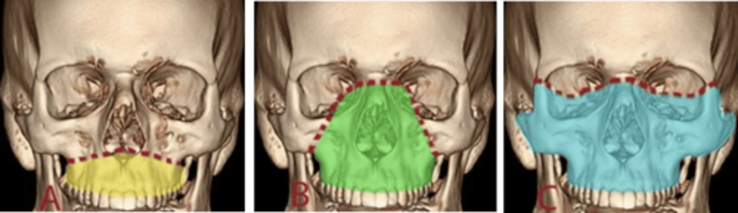 <p>Fractures occur in the maxilla and separate the teeth from the upper face</p>
