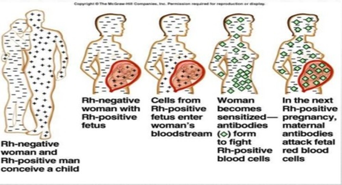 <p>•IgM does not cross placenta.</p><p>•Rh- mothers exposed to fetal Rh+ blood (often during delivery) may make anti-D IgG</p><p>• In subsequent pregnancies, anti-D IgG crosses the placenta causing hemolytic disease of the newborn (erythroblastosis fetalis) in the next fetus that is Rh+.</p><p>•Prevented by administration of RhoGAM to Rh - pregnant women during third trimester, which prevents maternal anti-Rh IgG production.</p><p>Rh - mothers have anti-D IgG only if previously exposed to Rh+ blood</p>