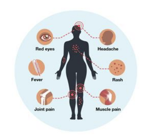 <ul><li><p>Congenital effects and foetus effects </p></li><li><p>1947 in rhesus monkey in Zika forest, Uganda</p></li><li><p>4 million in Americas 2016</p></li><li><p>Will increase with climate change </p></li></ul><p></p>
