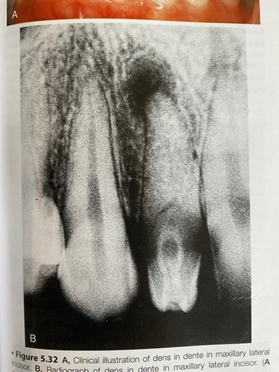 <p>Dens in dente</p>