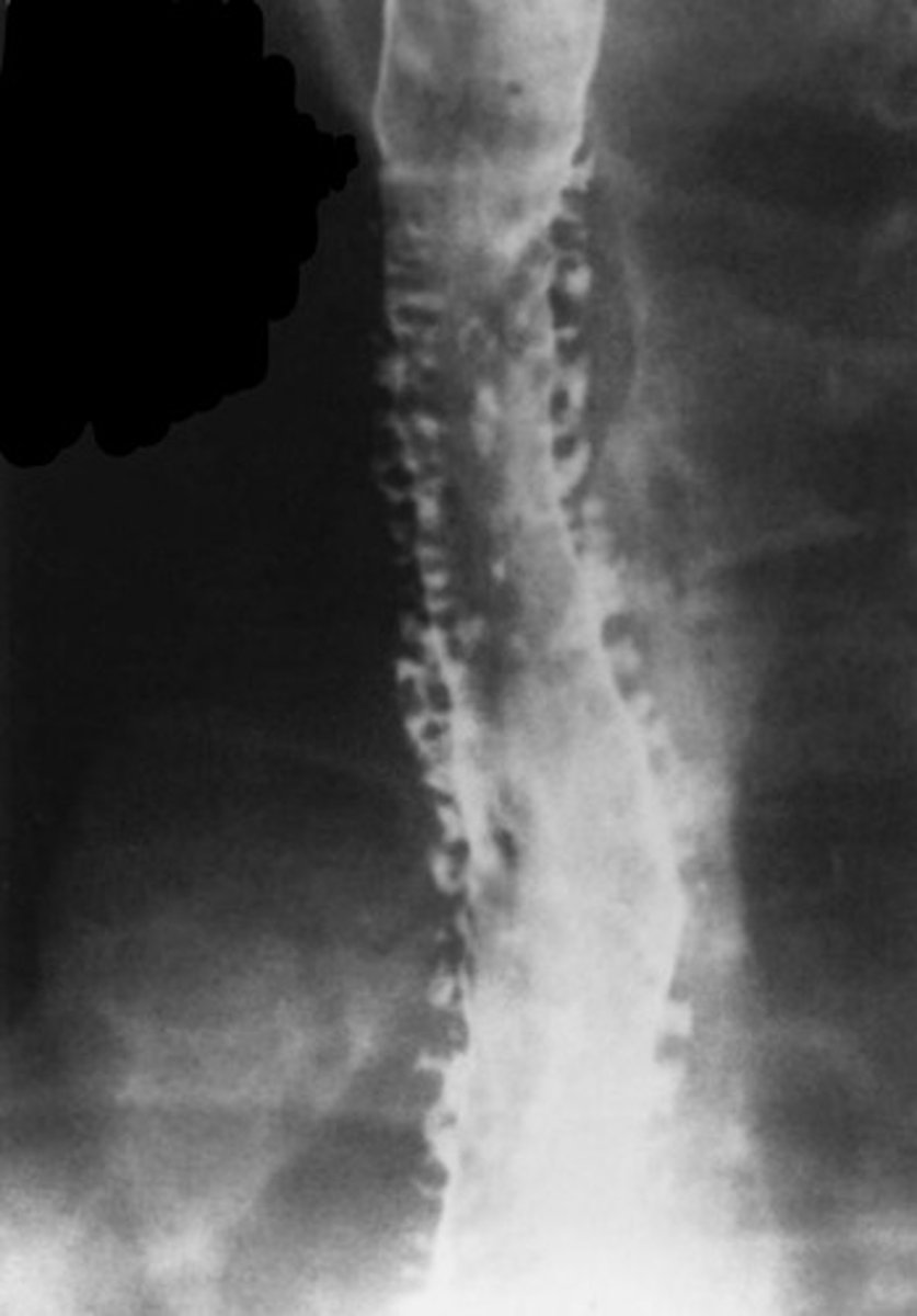<p>barium esophagram showing ducts of esophageal submucosal glands</p>
