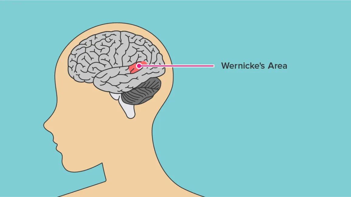 <p>wernicke’s aphasia</p>