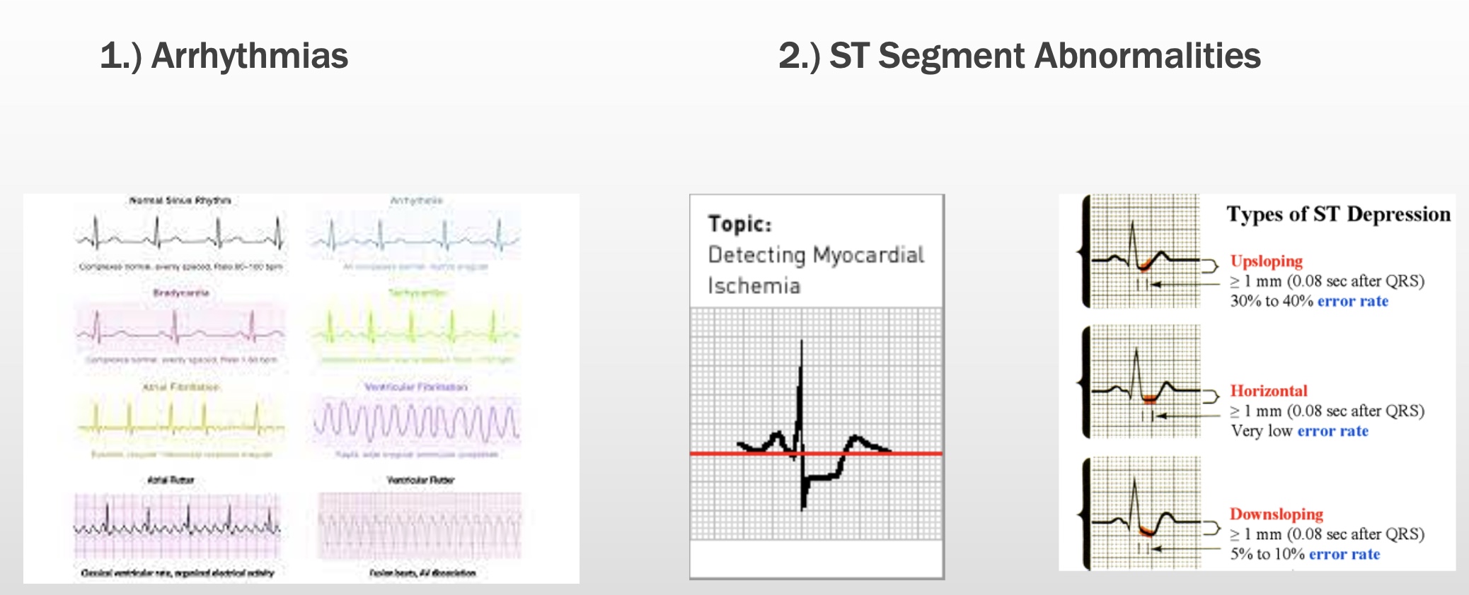 <p><span style="font-family: &quot;Franklin Gothic Medium&quot;;"><strong>1.) Arrhythmias&nbsp;</strong></span></p><p><span style="font-family: &quot;Franklin Gothic Medium&quot;;">-rhythm not expected at a given time</span></p><p><span style="font-family: &quot;Franklin Gothic Medium&quot;;">*ex:&nbsp;“sinus arrhythmia” w/ breathing is normal</span></p><p><span style="font-family: &quot;Franklin Gothic Medium&quot;;"><strong><mark data-color="yellow" style="background-color: yellow; color: inherit;">2.) ST Segment Abnormalities</mark></strong></span></p><p><span style="font-family: &quot;Franklin Gothic Medium&quot;;">-ST depression=<mark data-color="green" style="background-color: green; color: inherit;">2mm</mark> depressed; coronary arteries not getting enough O2</span></p><p><span style="font-family: &quot;Franklin Gothic Medium&quot;;">-ST elevation= active myocardial infarction</span></p>
