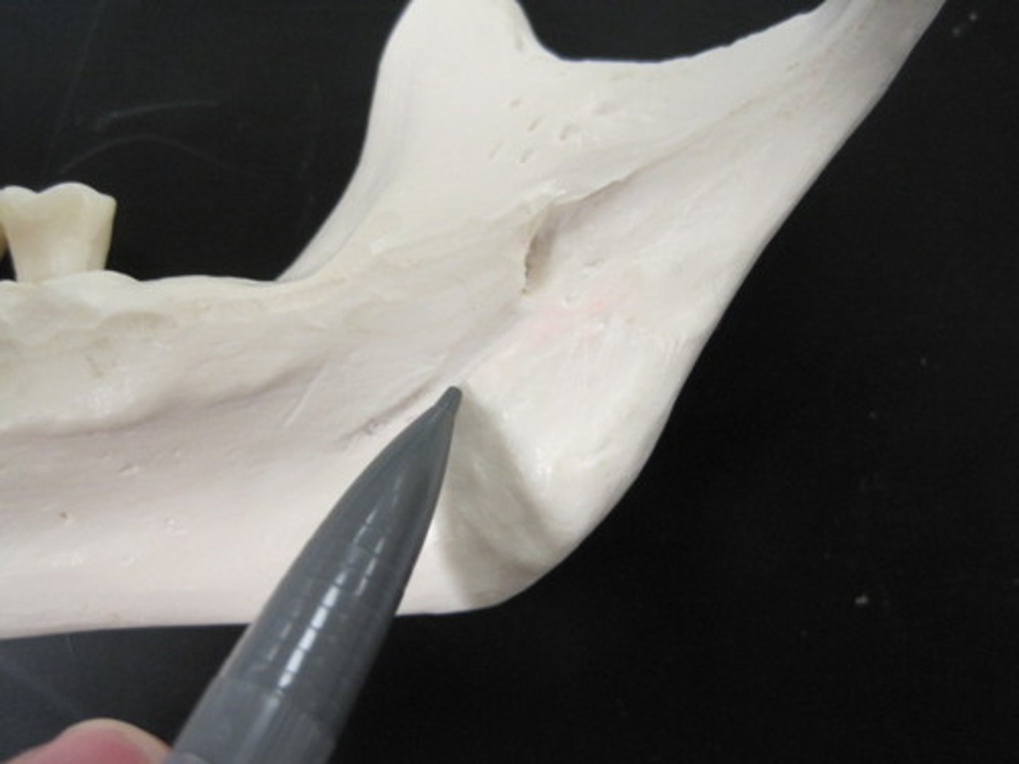 <p>Crosses the medial surface of the ramus, running anteroinferiorly from the edge of the mandibular foramen</p>