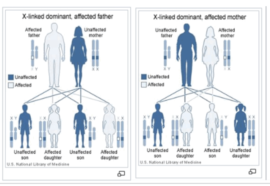 <ul><li><p>males and females affected (often more females)</p></li><li><p>Females usually less severely affected due to 2nd X</p></li><li><p>Males transmit to ALL daughters and never sons</p></li><li><p>Affected females transmit to 50% of her offspring</p></li></ul><p>E.g. incontinnentia pigmenti</p><p></p>