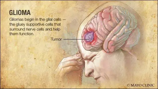 <p>A type of brain tumor that develops from glial cells, which are the supportive cells of the brain and spinal cord. These tumors can be either benign (non-cancerous) or malignant (cancerous). </p>