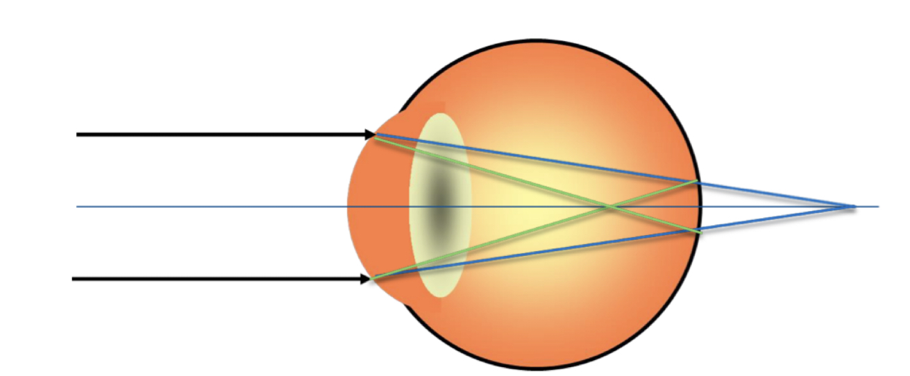 What type of astigmatism is this?