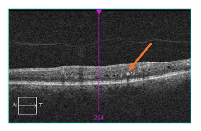 <p>hyper-reflective spot at ONL/OPL</p><ul><li><p>can be associated with clear/hypo-reflective cystic spaces (fluid/edema)</p></li><li><p>posterior shadowing</p></li><li><p>lead to fibrotic scarring and loss of retinal structures</p></li></ul><p></p>
