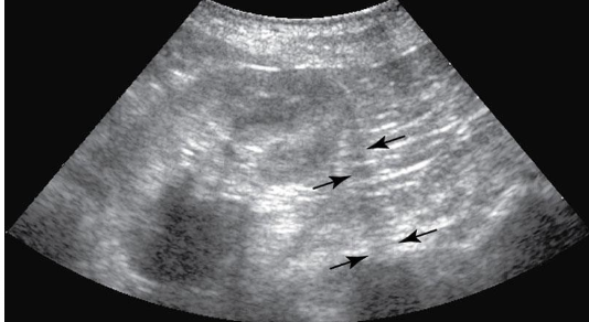 <ul><li><p>most common with round fluid filled structures</p></li><li><p>occurs at edge parallel to the sound beam</p></li><li><p>causes a dark shadow from edge of structure</p></li><li><p>gallbladder, urinary bladder, cysts, and sometimes kidneys</p></li></ul><p></p>