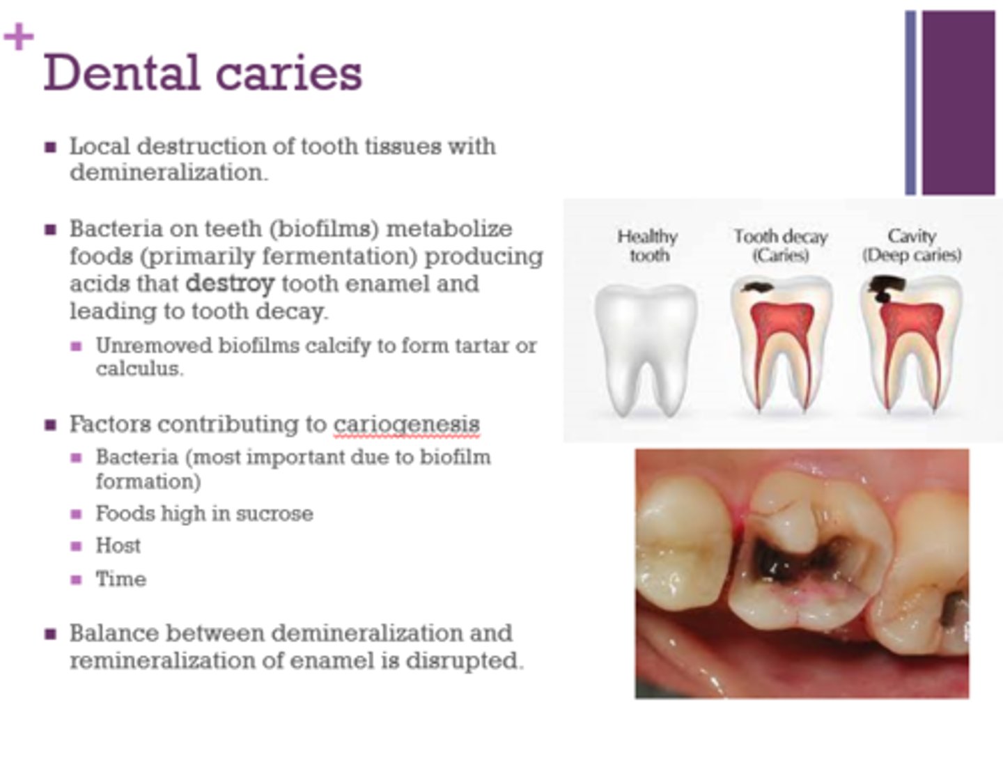 <p>Bacteria on teeth metabolize foods producing acids that destroy tooth enamel and lead to tooth decay</p>