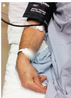 <p>Inflate a <span>sphygmomanometer cuff above systolic blood pressure</span></p><p><span>Carpopedal spasms of the hand will be visible</span></p><p><span>Occlusion of the brachial artery causes flexion of the wrist and metacarpophalangeal joints, hyper-extension of the fingers, and flexion of the thumb on the palm</span></p><p><span>Hypocalcaemia induced excitability of the nerves in the arm and forearm results in spontaneous firing of nerves fire when subjected to Ischemia after inflating the cuff</span></p>