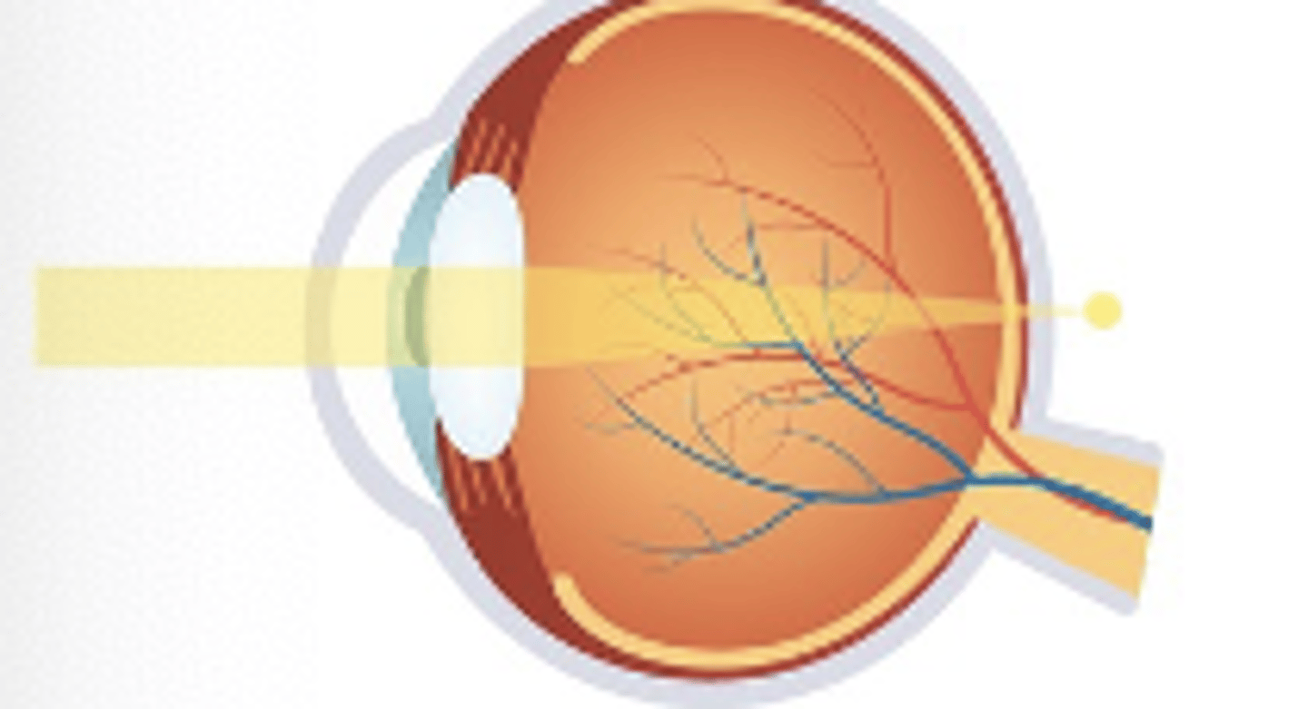 <p>-Lower amount are asymptomatic</p><p>-Vision worse at near than distance</p>