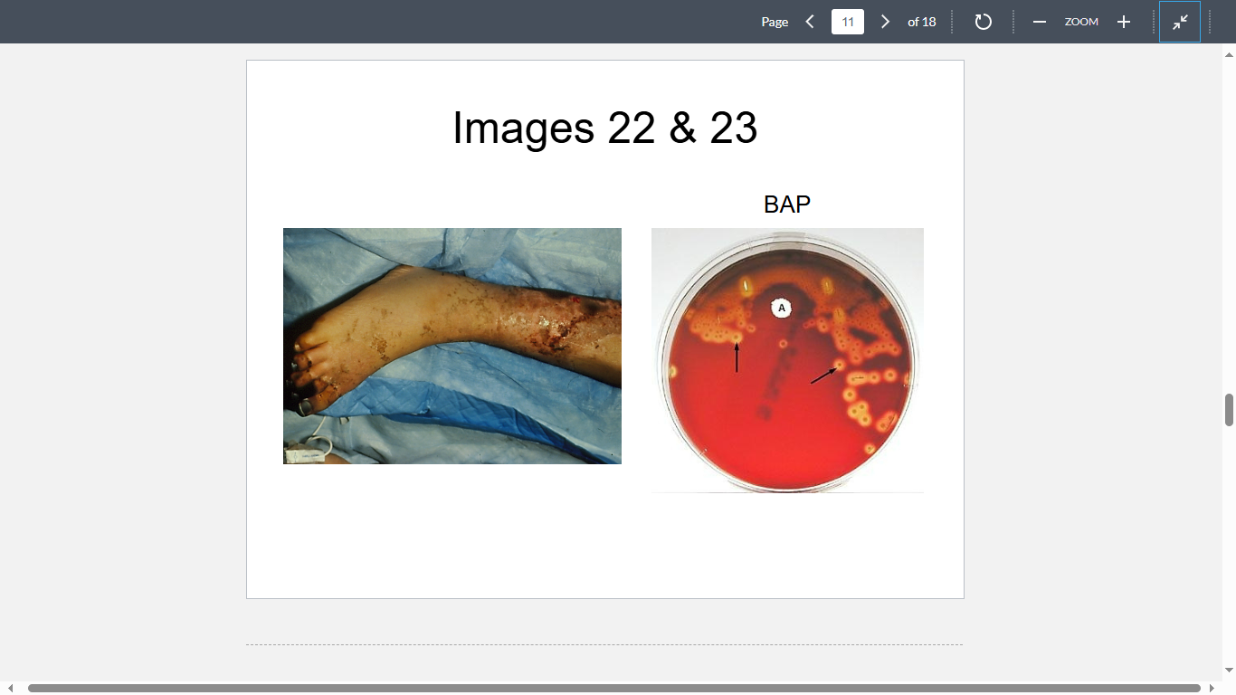 <p>Image 22 depicts the right lower extremity of a 14-year-old high school student whose history was remarkable for a case of Scarlet fever that had started six days prior to his hospitalization. At the time of admission, the patient was hypotensive, and not responsive to verbal communication. He also had diffuse rash and according to his mother, had not produced urine for at least 10 hours. His blood culture is shown in Image 23. Which of the following contributed most to his current condition?</p>