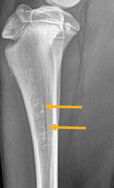 <p>In the cortex of the proximal diaphysis in long bones</p>