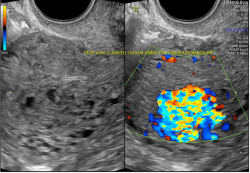<p><span>Sonographic findings of subtle myometrial inhomogeneity, tubular spaces within the myometrium, intramural uterine mass, endometrial or cervical mass, or prominent parametrial vessels are present with what?</span></p>