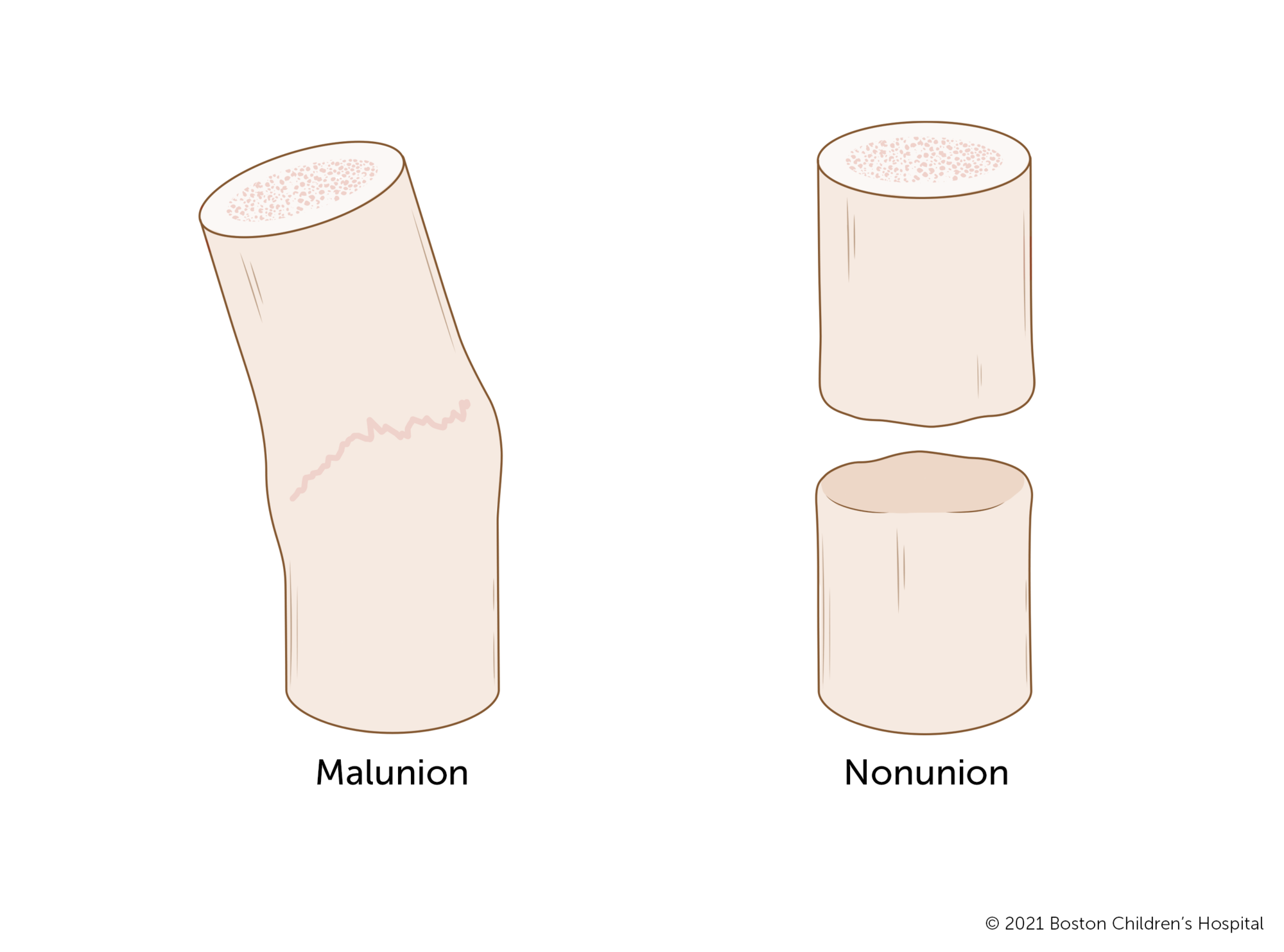 <p>Bone stopped healing &amp; never fully repaired</p><ul><li><p>Tx: Bone Grafts, Electrical Stimulation (stimulates osteoblasts)</p></li></ul><p></p>