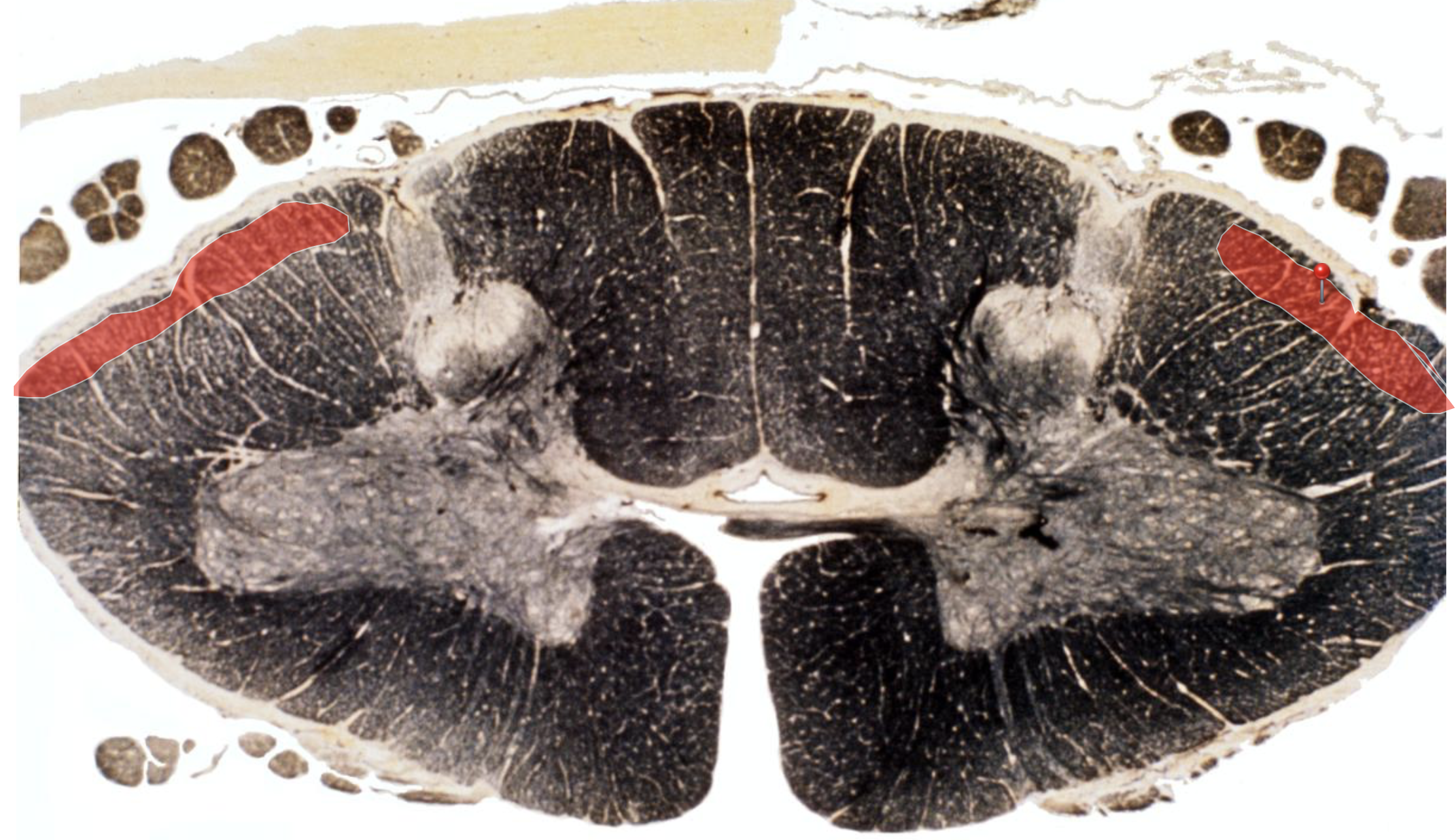 <p>Dorsal Spinocerebellar Tract</p>