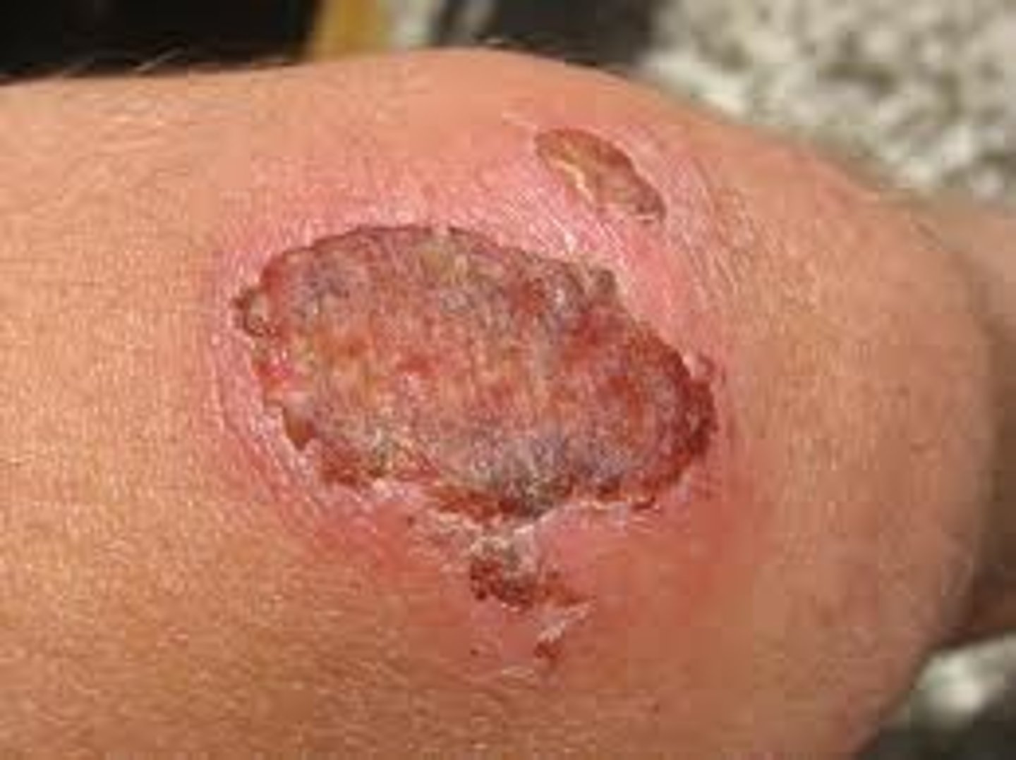 <p>secondary lesion; dead cells that form over a wound or blemish while healing</p>