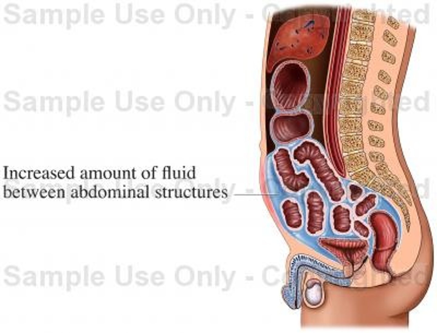 <p>false. ascites is a common Sx of intrahepatic and posthepatic blood flow obstructions (NOT prehepatic). in prehepatic there is no hepatomegaly so the fluid isnt being pushed out into the tissues</p>