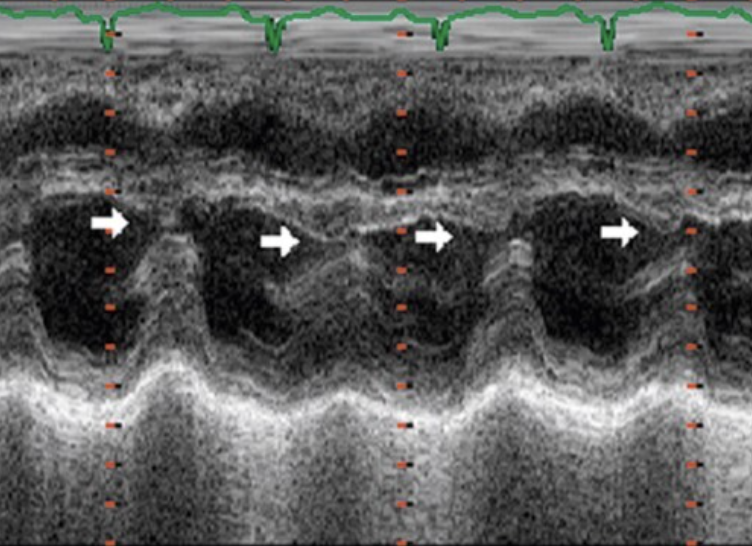 <p>constrictive pericarditis - ventricles must "share space"</p>