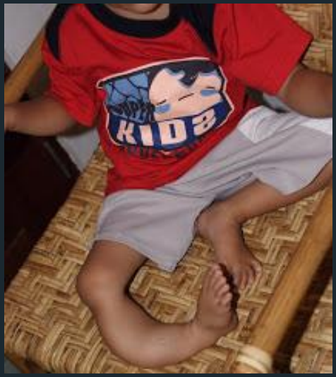 <ul><li><p>if jaw involved, facial asymmetry may result </p></li><li><p>pain, due to pathologic fracture of the long bones </p></li><li><p>hockey stick deformity- leg length discrepancy </p></li></ul><p></p>