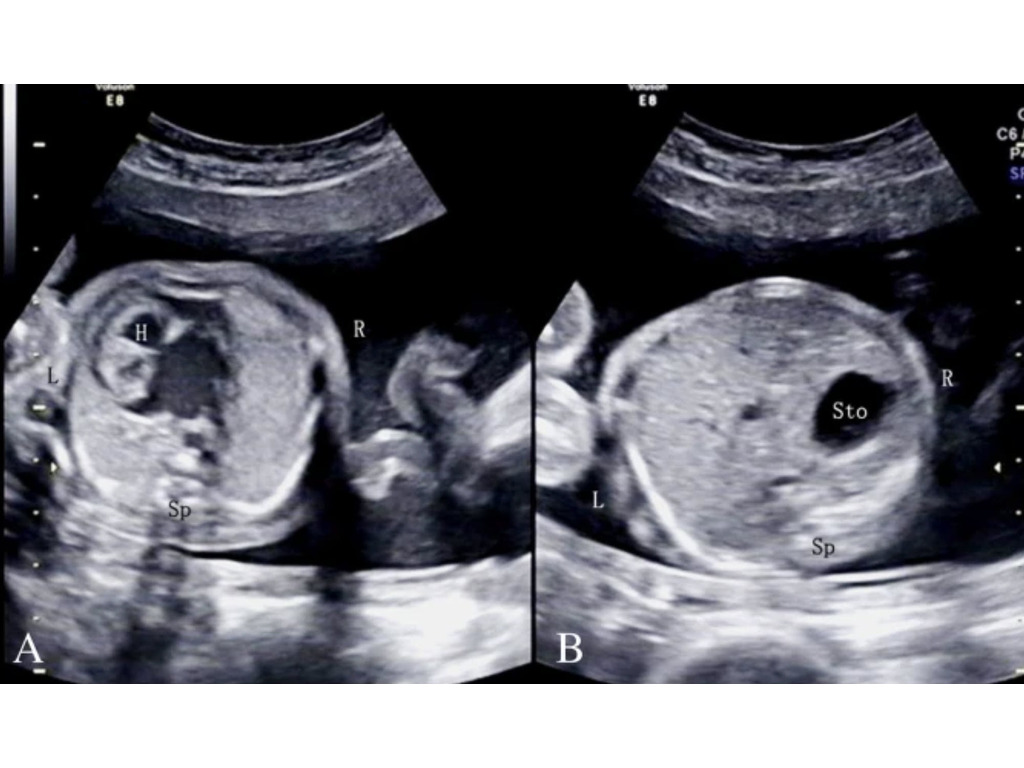 <p><span>Vertex fetus. The findings are consistent with?</span></p>