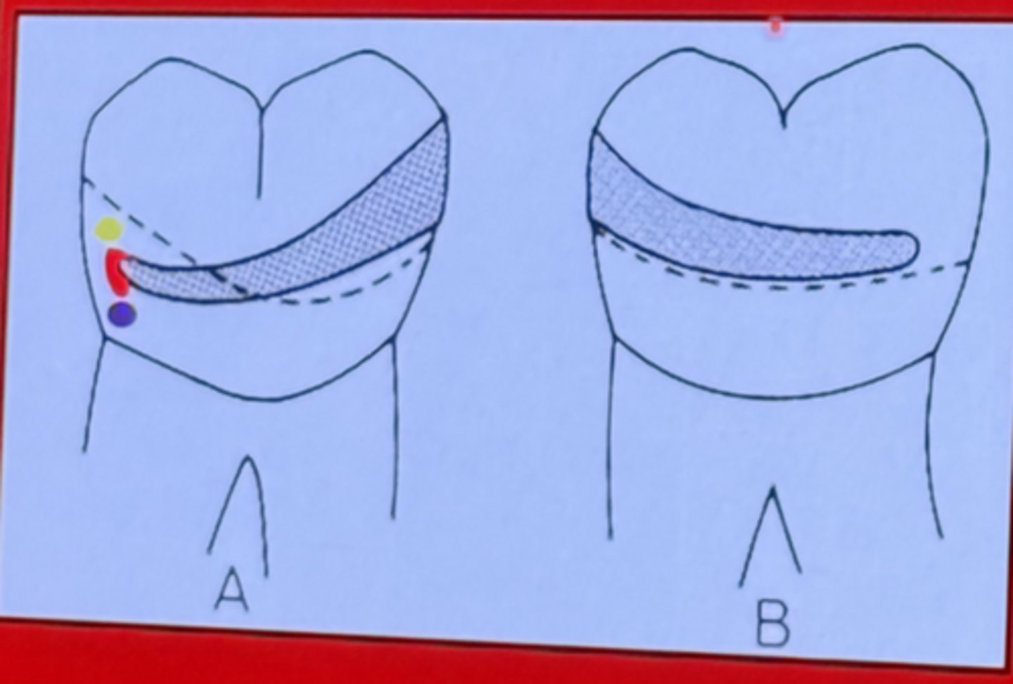 <p>0.01 undercut</p>