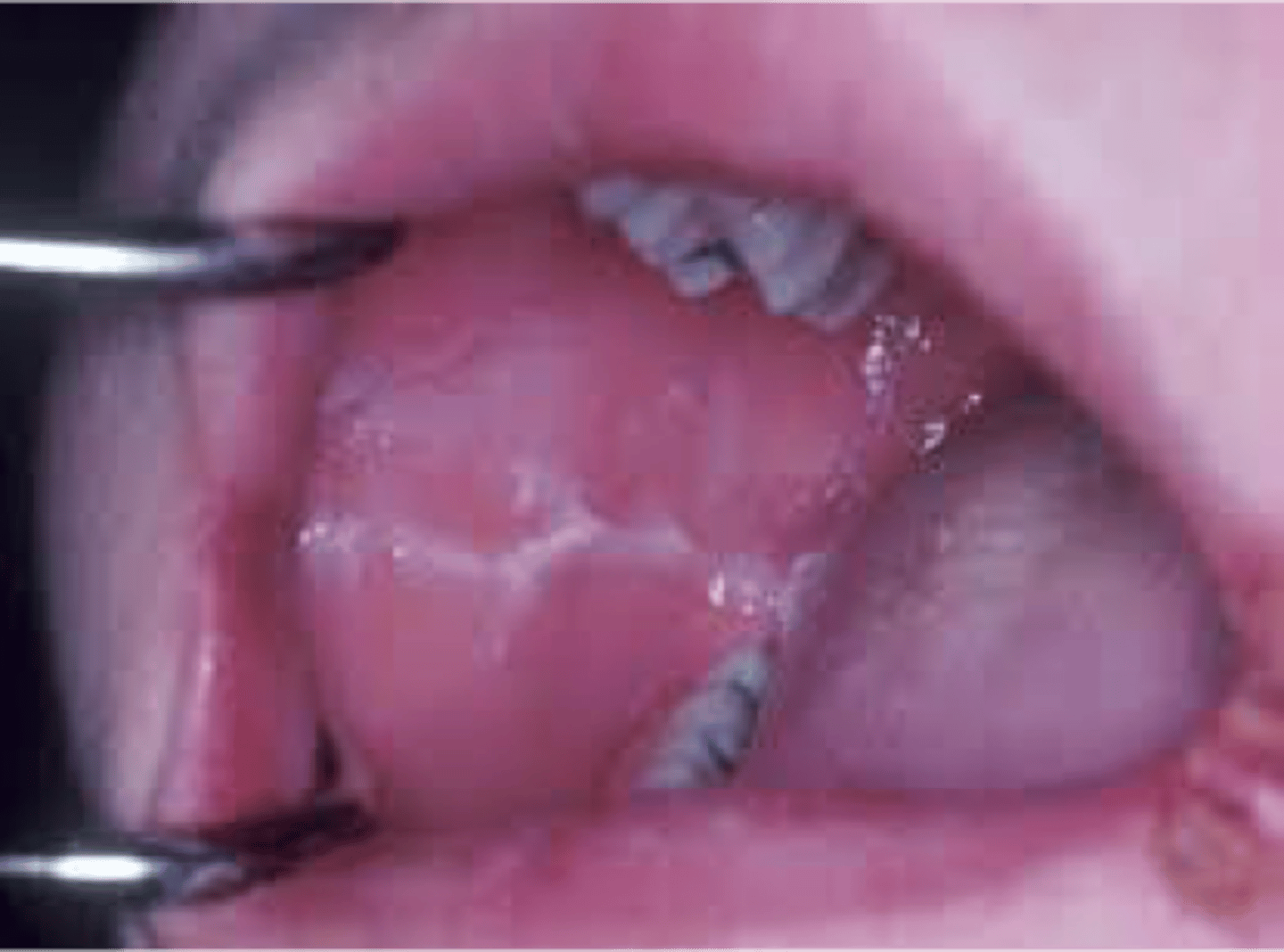<p>is linea alba a normal finding?</p>