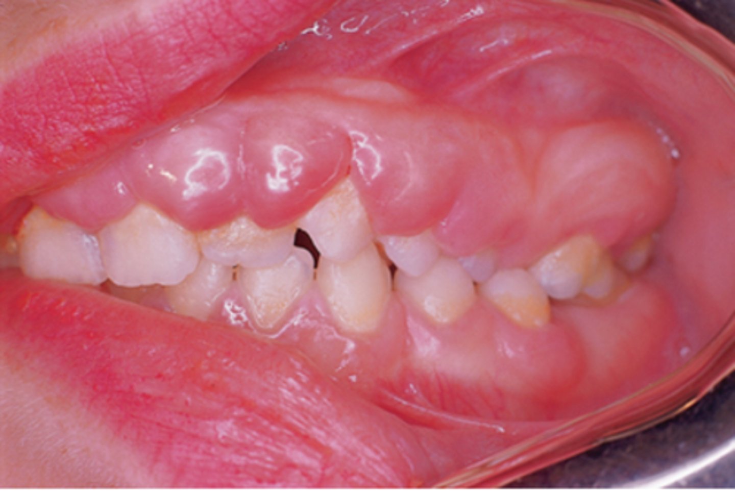 <p>increase in number of cells present causing inflammation</p><p>tx: gingivectomy, OHI</p><p>mostly due to medication side effect</p><p>medications include: anti seizure medication (phenytoin) hypertensive (procardia)</p><p>antirejection (cyclosporine)</p><p>Orthodontic appliance may contribute as irritant</p><p>Other causes: Hormonal changes, xerostomia, and heredity</p>