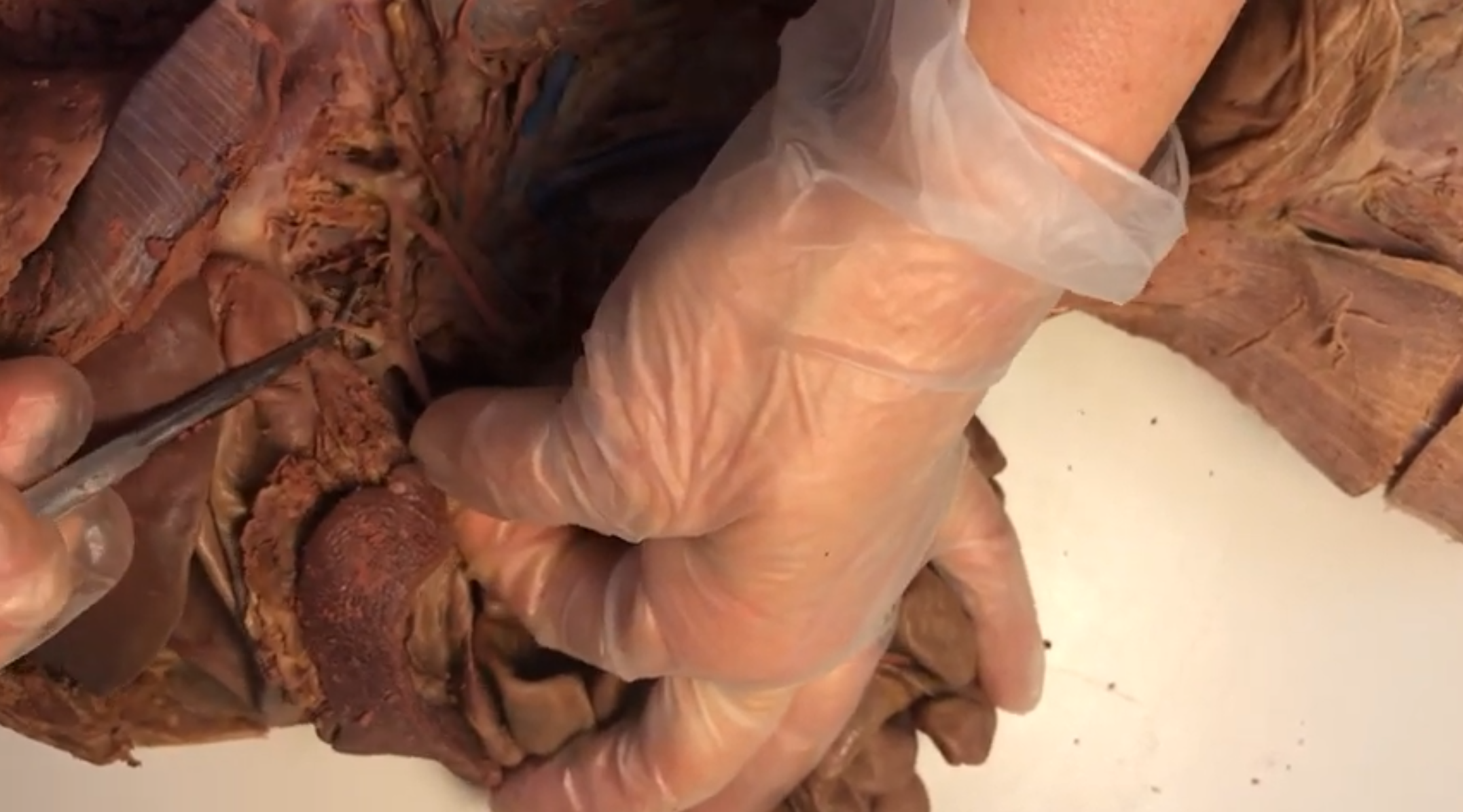 <p>What artery is this</p>