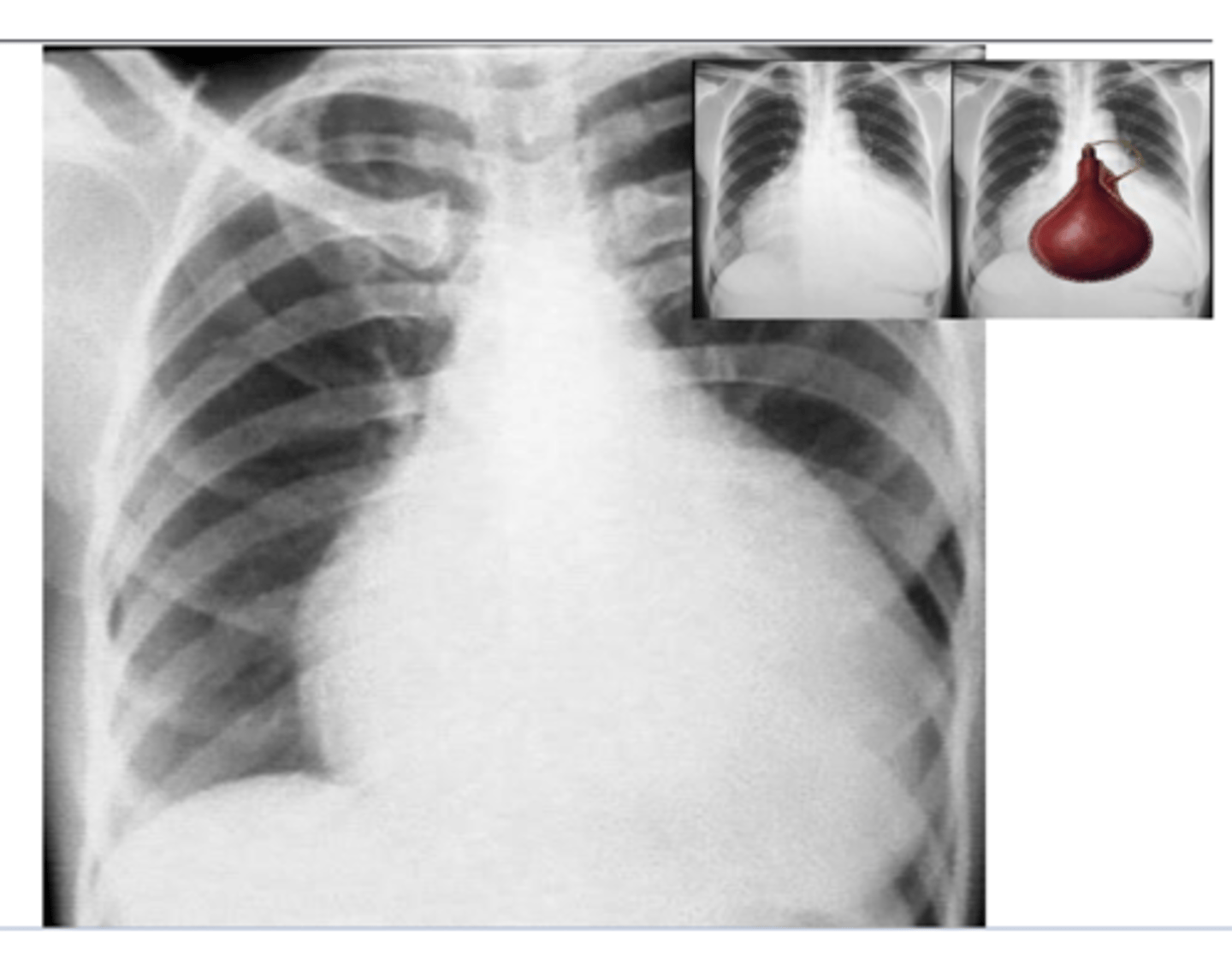<p>Pericardial effusion causes an acute marked</p><p>enlargement with the heart appearing pendulous and very wide at the base – “water bag appearance.”</p><p>echocardiogram is imaging of choice (image here is x-ray)</p>