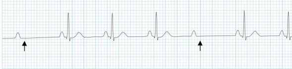 <p>What does this EKG show?</p>