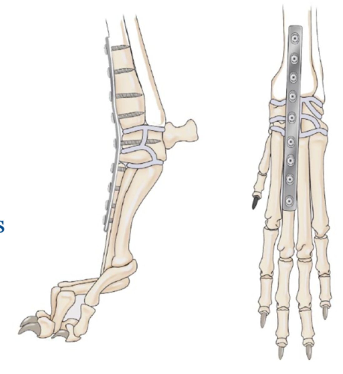 <p>How can you treat carpal hyperextension?</p>