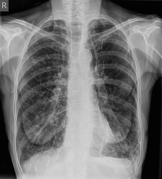 <p>Define, RA and symptoms</p>