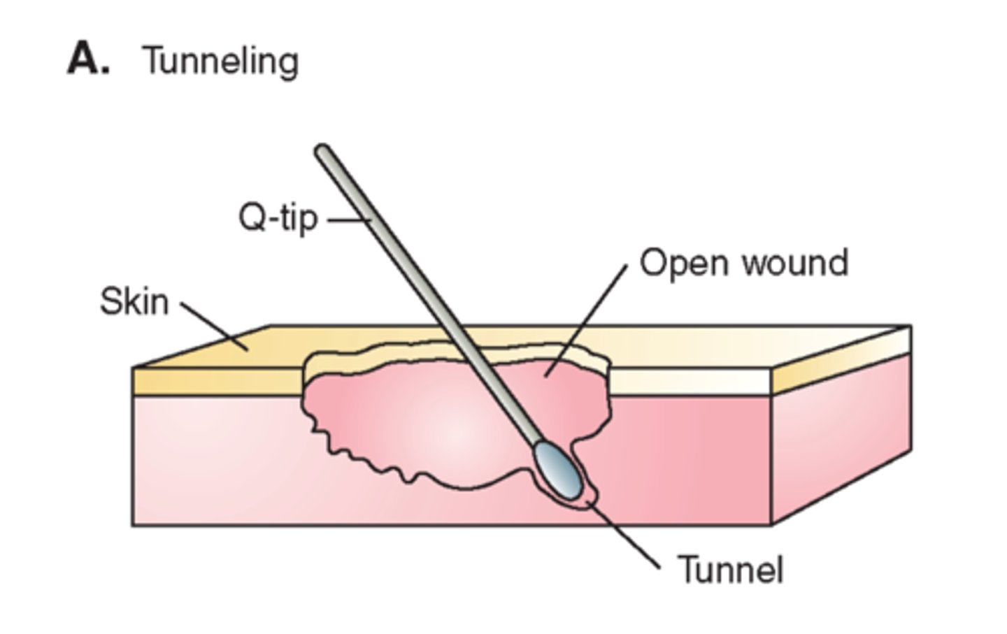 <p>subcutaneous opening or tract/tunnel under the wound surface in any direction</p><p>*insert sterile cotton-tipped applicator for depth/length of tunnel</p><p>**measure in cm at o'clock positioning</p>