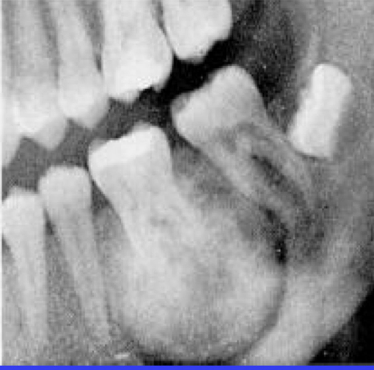 <p>Bulbous growth at apex</p>