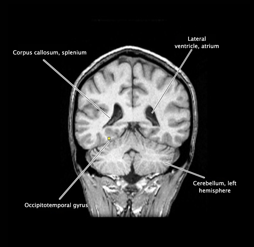 <p>Occipitotemporal gyrus</p>
