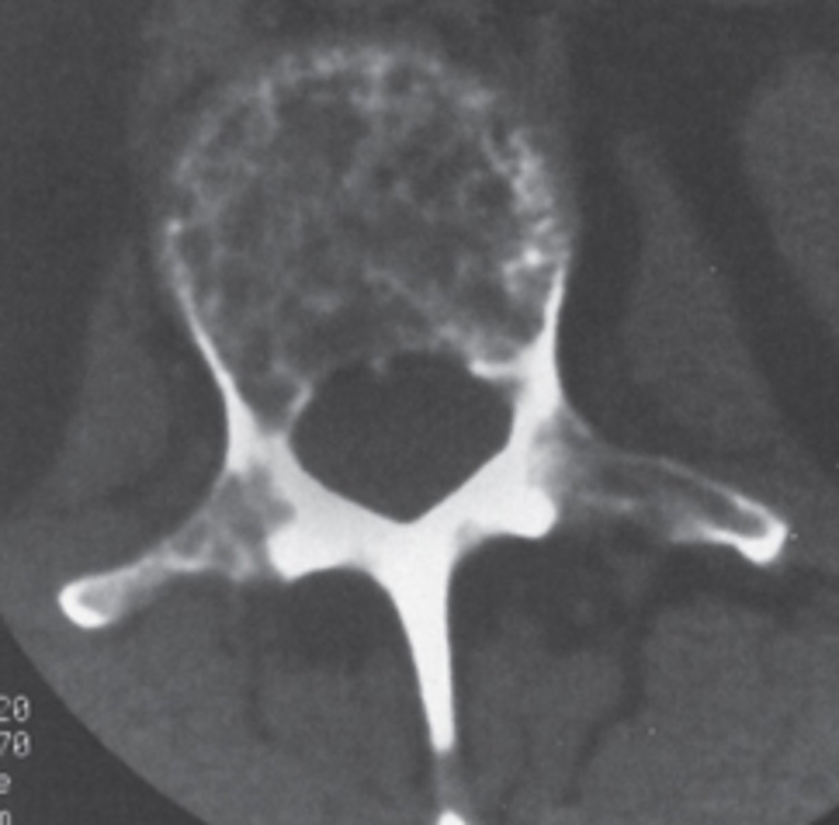 <p>What diagnostic possibilities should be most seriously considered?</p><p>Congenital or traumatic lesions</p><p>Metabolic or endocrine disease</p><p>Myeloma or metastatic disease</p><p>Infectious or inflammatory disease</p><p>Degenerative or inflammatory disease</p>