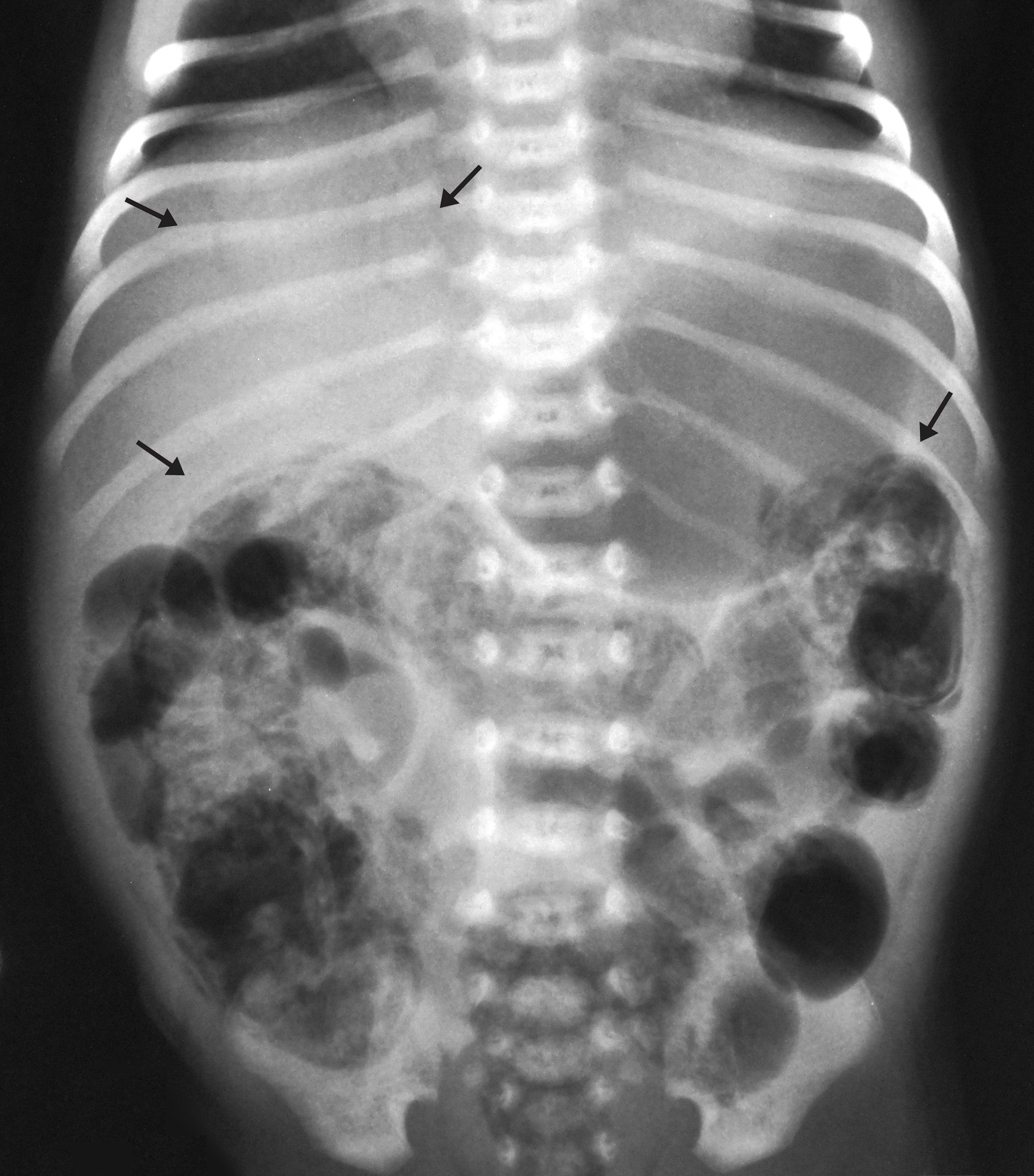 <p>PED - (USP SP 21 + UNICAMP 25) enterocolite necrotizante: diagnóstico e tratamento </p>