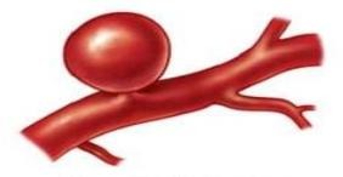 <p>Weak bulge in the wall of a blood vessel.</p>