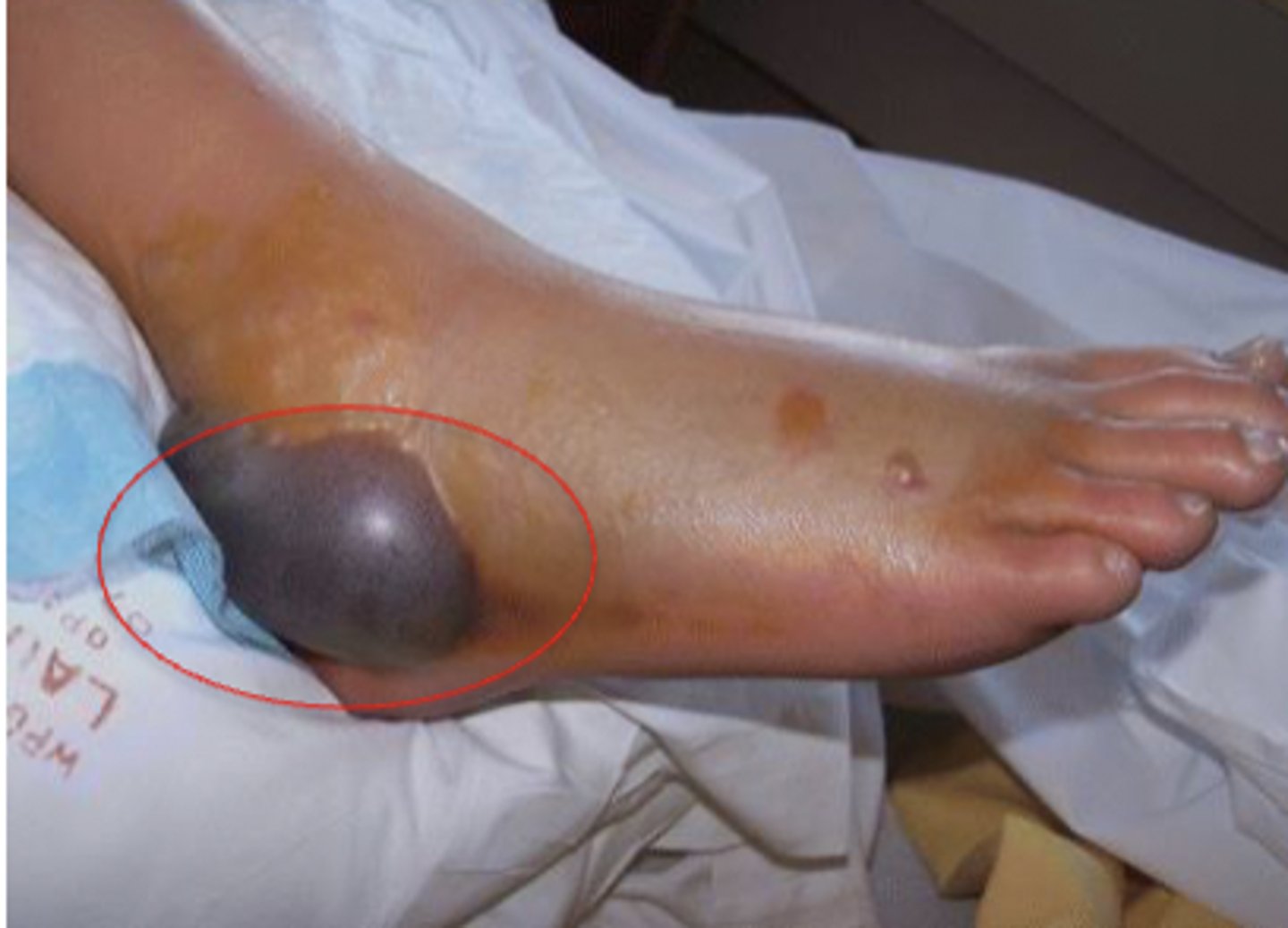 <p>> 5mm (blister)</p>