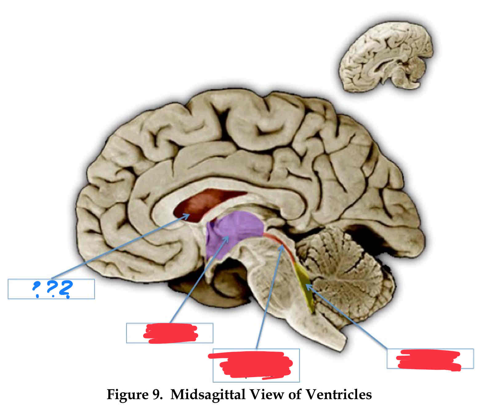 <p>side ventricle</p>