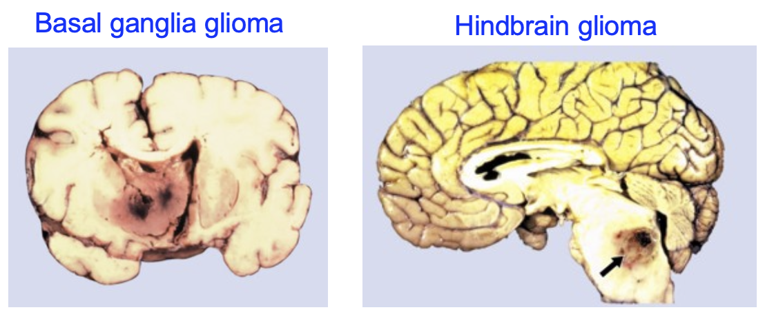 <p>→ type of <strong>malignant brain tumor</strong> made from poorly differentiated glial cells (tumor initiating cells originate from the neural stem cells that make giia)</p><ul><li><p>Rapidly proliferates</p></li><li><p>↑ Resistance to chemotherapy and radiation than other tumor cells</p></li><li><p>↑ Mortality rate</p></li></ul><p></p>